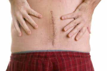 lumbar back surgery thumbnaiil
